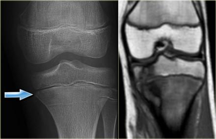 Osteomyelitis Broad spectrum of radiographic features. May occur at any age, no typical location.