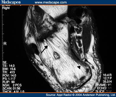 Figure 6. Paget's disease involving the calcaneus in a 50 year old man.