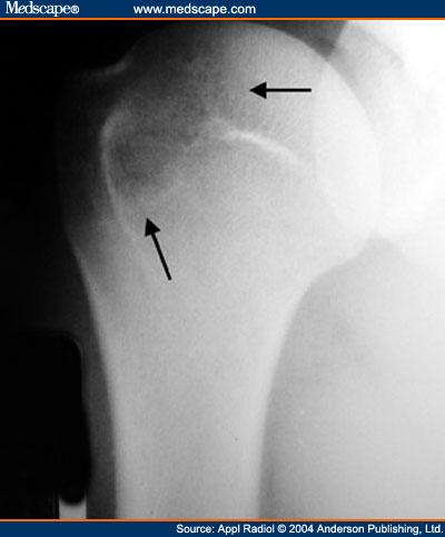 Figure 1. Proximal humeral anteroposterior (AP) pseudocyst in a 22 year old man.