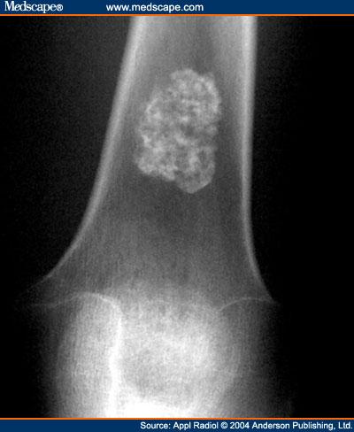 Figure 10. Enchondroma of the distal femur in a 45 year old woman.