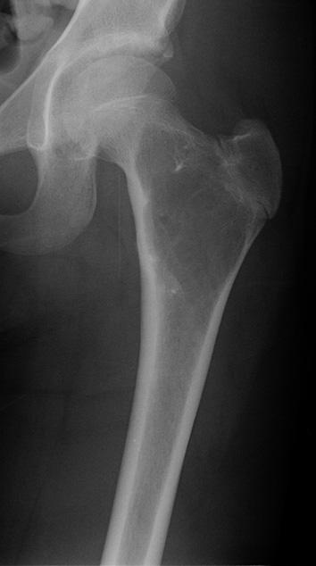 poorly visible and barely perceptible, making it difficult to identify the lesion on radiographs.