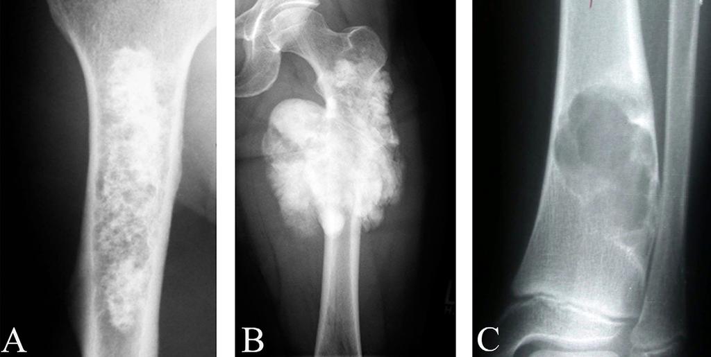 Radiographic and Scintigraphic Evaluation of Bone Tumors and Diseases Fig.