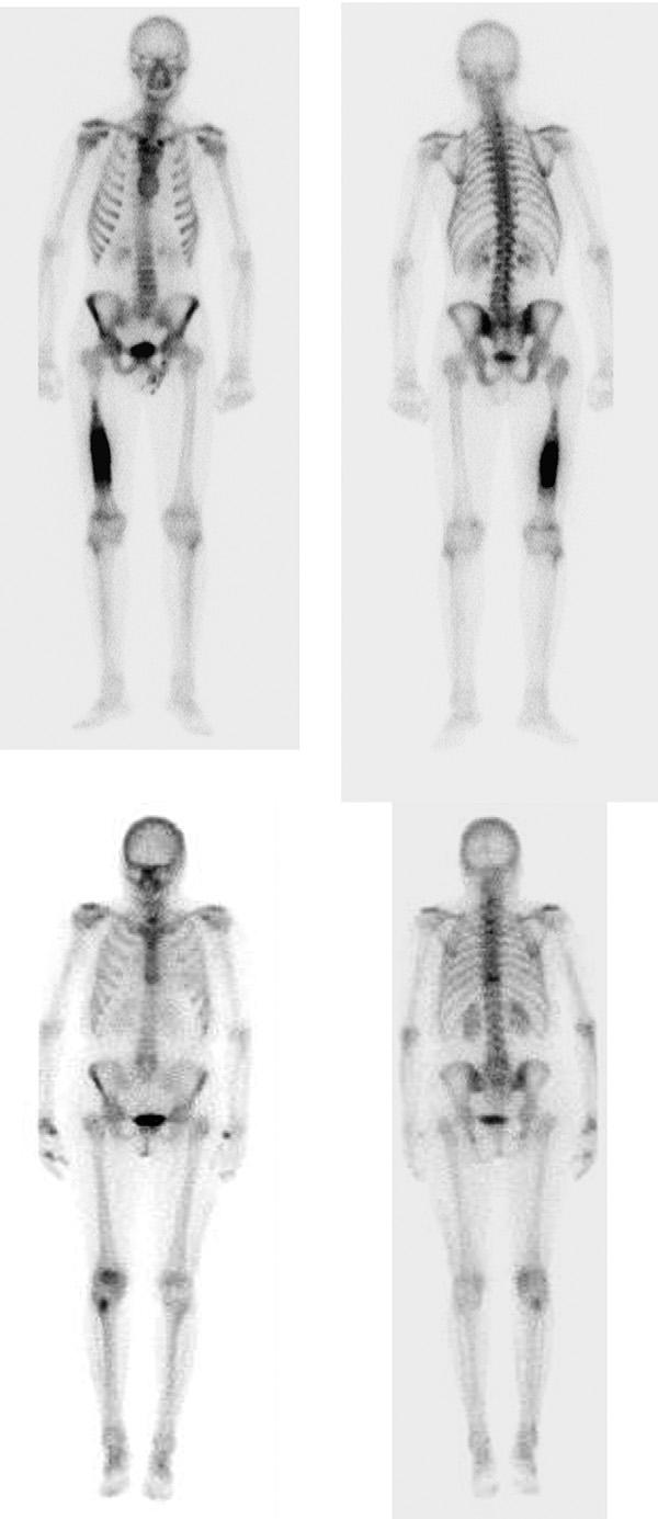 Radiographic and Scintigraphic Evaluation of Bone Tumors and Diseases Fig.