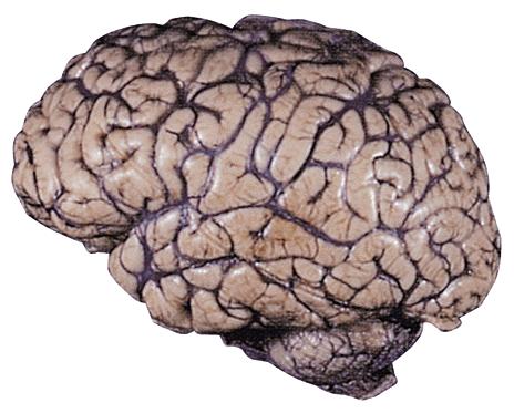 2. Lesions The removal or destruction of part of the brain.