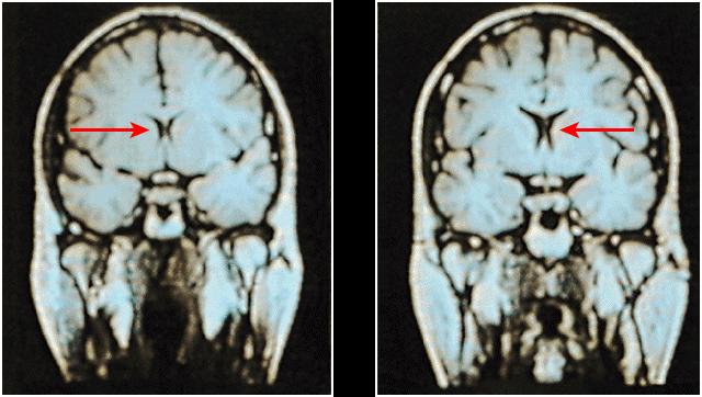 MRI Scan MRI scan of an healthy individual (left) and person with