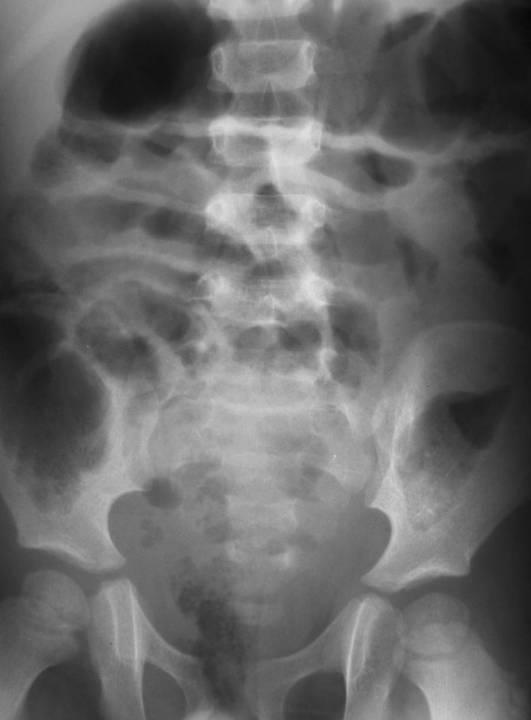 Rectal perforation Usually seen with sexual abuse Pancreas and Duodenum Injuries Less than 5% of abdominal injuries Blows to