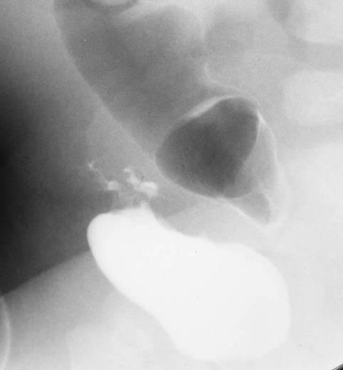 Intraperitoneal Bladder Rupture Points to Remember Keep blunt injury in mind, even when there is no clear history of trauma.