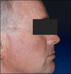 75% for the treatment of actinic keratoses: Results of two placebo-controlled