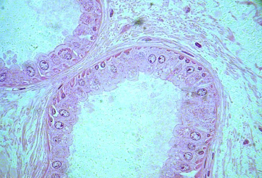Human Axilla: Apocrine Sweat Glands (arm pit & crotch area) note copius secretion granule formation and Myoepithelium smooth muscle fibers (arrows) at base