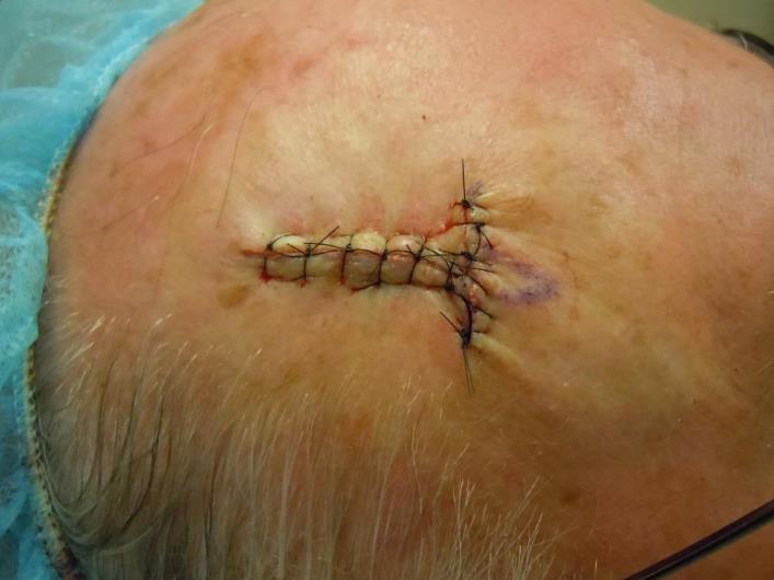 age, complexion; dermis sutured separately