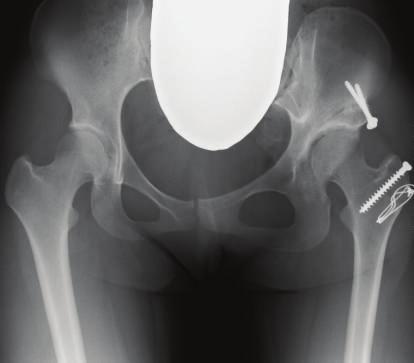 The patient had achieved anatomical correction with an adequate bone stock in the hip joint.