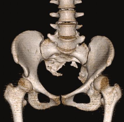 Case Reports in Orthopedics 3 Figure 2: Pelvic three-dimensional CT reconstruction images demonstrated partial left sacral agenesis, in which a rudimentary sacrum had fused with the ilia below the