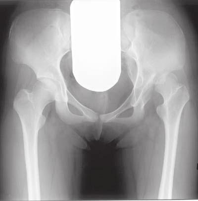 4 Case Reports in Orthopedics Figure 4: A 13-year-female with left hip subluxation associated with acetabular dysplasia and partial sacral agenesis. A preoperative AP radiograph of the pelvis.