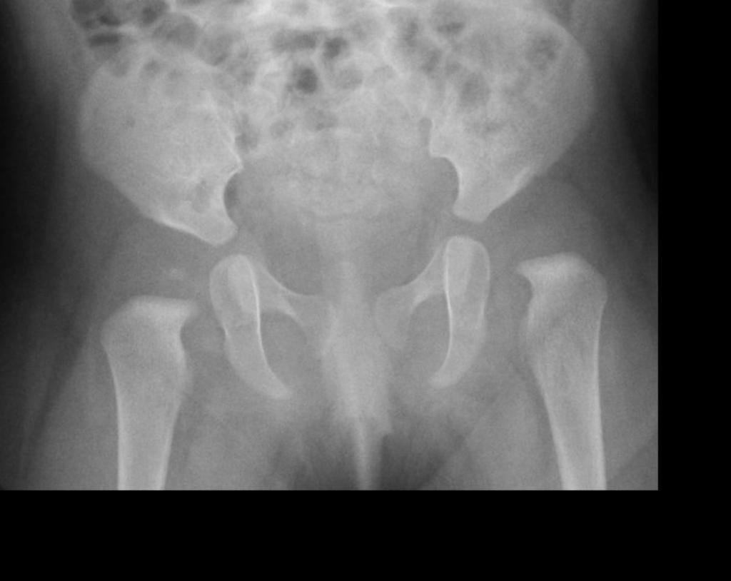 Fig. 10: L sided DDH with delayed ossification of the femoral head