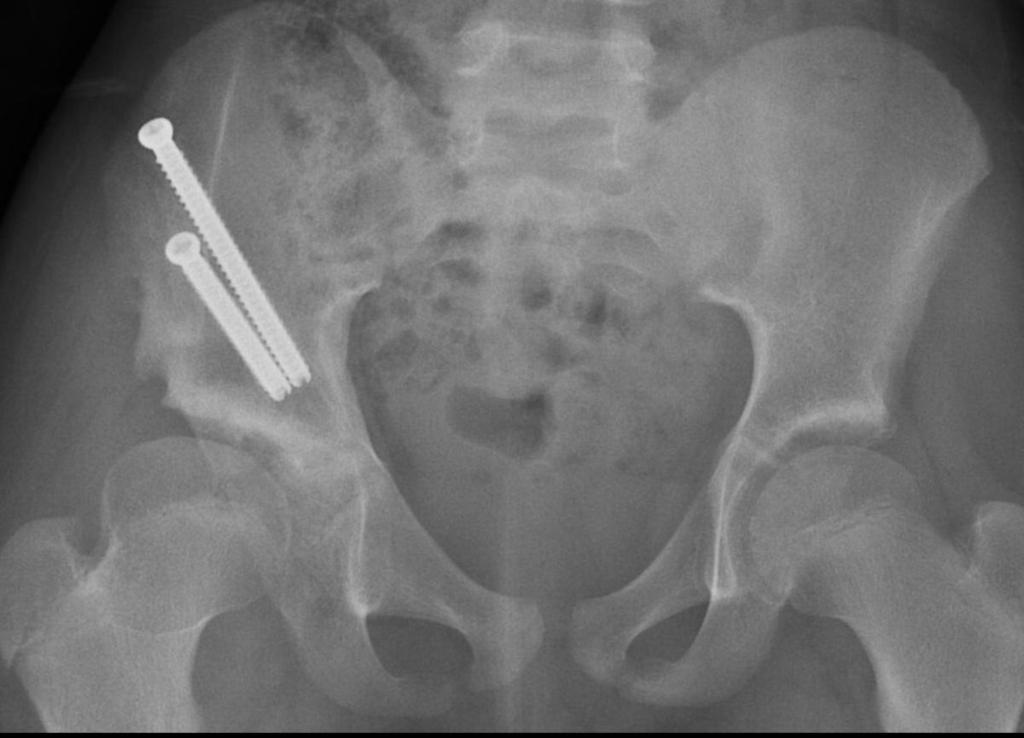Fig. 14: Right DDH treated with pelvic osteotomy.