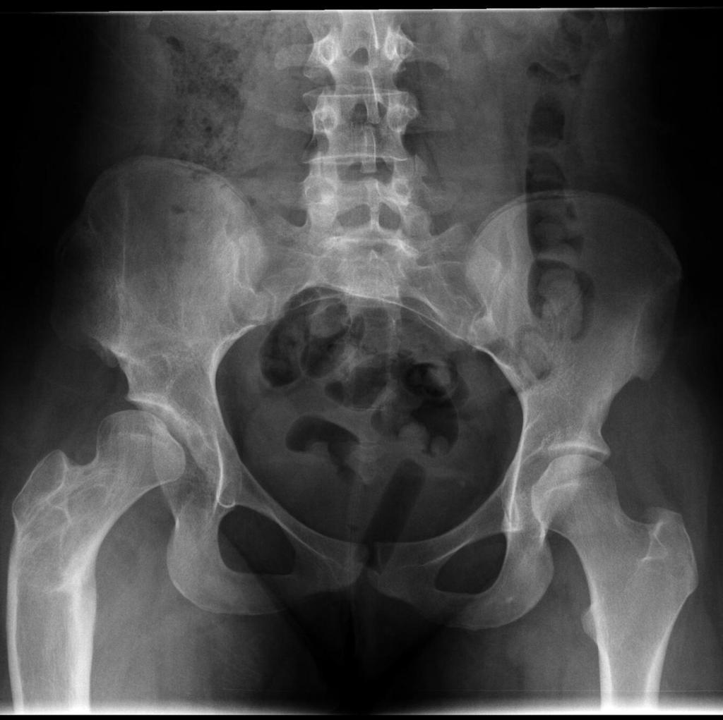 Fig. 15: Adult pelvis, DDH treated with childhood osteotomies.