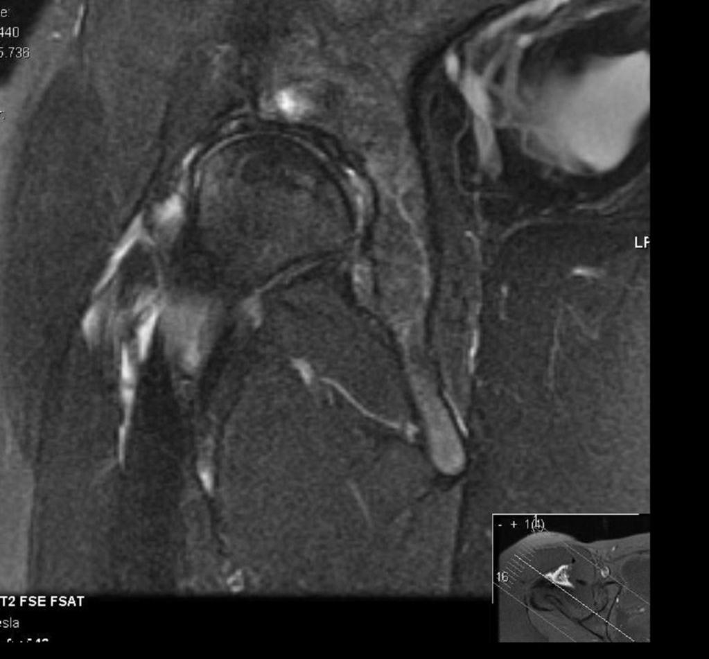 Fig. 16: MRI of the same patient as fig 16 Note the oedema within the acetabulum with a small