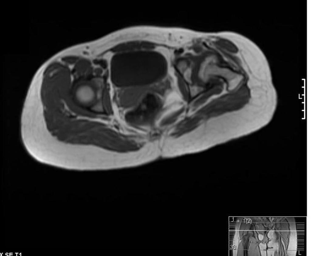 Fig. 8: Axial T1W MRI showing dysplasia of the left femoral head and post osteotomy appearance of the acetabulum.