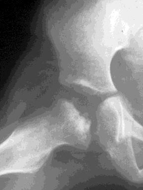 Perthes Disease Avascular necrosis of femoral head Aetiology still unclear Treatment extremely controversial Activity modification,