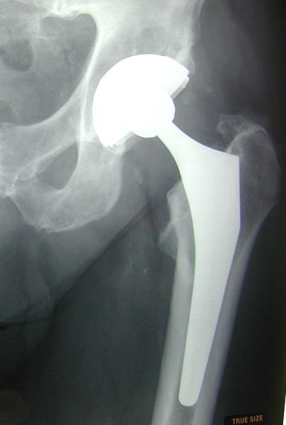 Total hip joint replacements When? Pain is the only reason to have one you tell me when you want to have one What type?