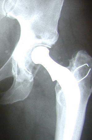 Revision Hip Joint Replacement Complex Newer instrumentation and implants making it easier Not all the
