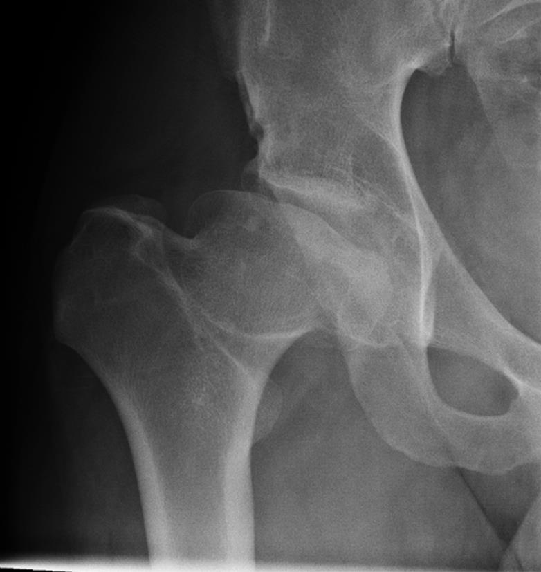 Definition Temporary osteonecrosis of the femoral head