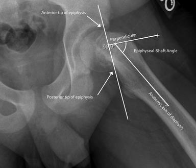 Slipped Upper Femoral Epiphysis Disorder of the proximal femoral