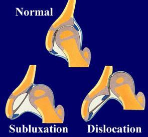 DDH Spectrum disorder Complete dislocation Subluxation Instability Acetabular