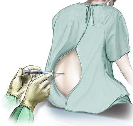 The epidural can be maintained by giving extra doses or by giving a continuous low dose (an infusion). Your anaesthetist will monitor you closely. How is an epidural given?