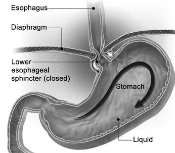 In normal digestion, swallowed food goes down the esophagus and into the stomach. What is achalasia?