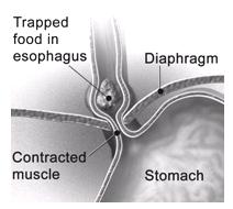 The food is moved by peristalsis, a series of wave-like muscle contractions. A muscle called the lower esophageal sphincter (LES) is at the bottom of the esophagus.