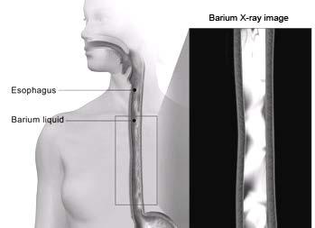 Barium Swallow Study A barium swallow study is often used to diagnose achalasia. In this study, you will swallow a contrast solution that contains barium.