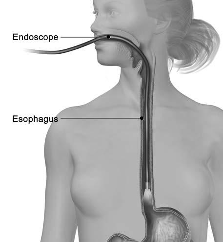 During an endoscopy, a thin, flexible tube called an endoscope is put down your throat. An endoscopy is needed to make sure that a tumor in the esophagus is not causing your achalasia symptoms.