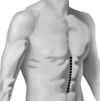 Myotomy is done using laparoscopy, a method that lets your surgeon work through very small incisions.