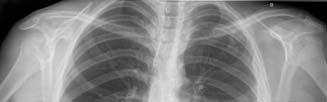 Perikardi TB. Perikardi tihkenemine, tuberkuloomid kopsus, parempoolne pleuraefusioon Tuberkuloosne pleuriit. EPTB, diagnoosimine 1. Põetud TB 2. EPTB sümptomid anamneesis 3.