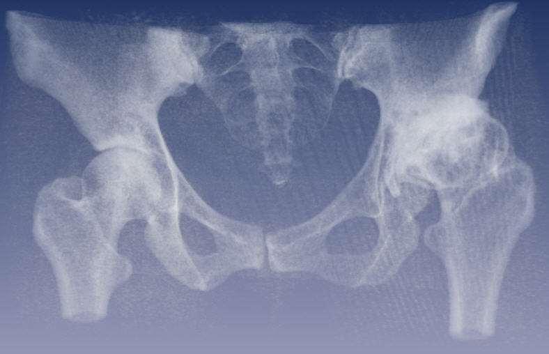 CONGENITAL HIP DISEASE IN YOUNG ADULTS CLASSIFICATION AND TREATMENT WITH