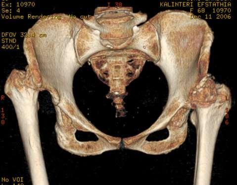 CONGENITAL HIP DISEASE IN YOUNG ADULTS THE DYSPLASTIC HIP WHY NOT?