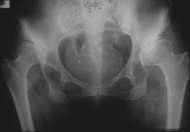 HIGH DISLOCATION THE FEMORAL HEAD IS MIGRATED SYPERIORLY AND