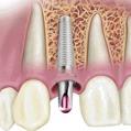 Perhaps you suffered an injury to your teeth with significant bone loss resulting in a large defect.