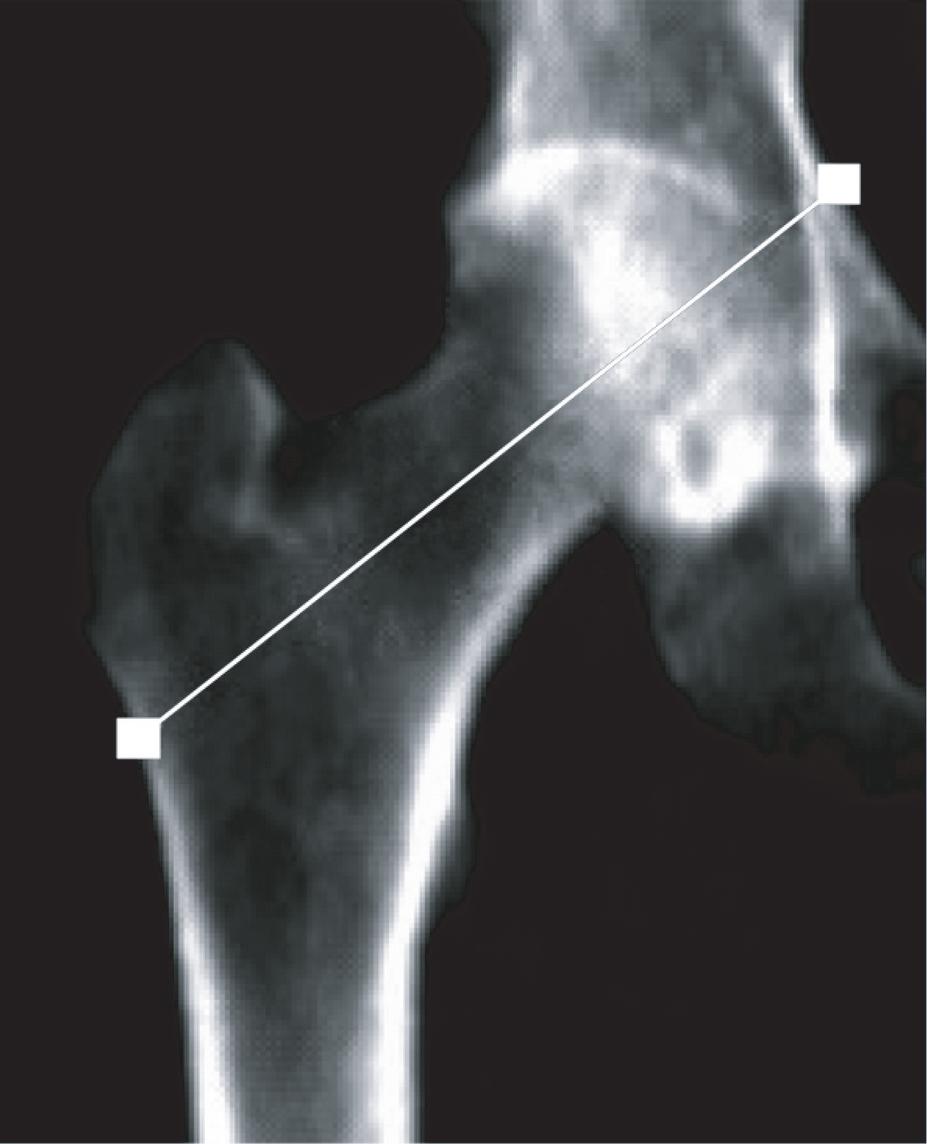 femur fracture secondary to the most common cause of such fractures.