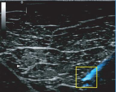 technology enhances the needle visualization on the ultrasound image.