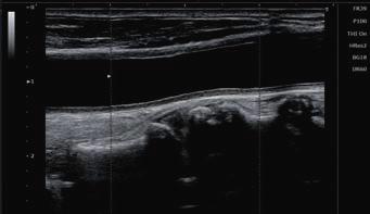 Strain Elastography Strain Elastography is an advanced real-time qualitative imaging method displaying the relative stiffness of tissues.