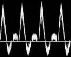Diagnosis Duplex imaging B Mode Velocities and Waveforms Gerhard-Herman M,