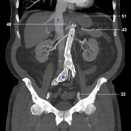 Diagnosis CTA Timing bolus dependent Generally good Aorto-iliac