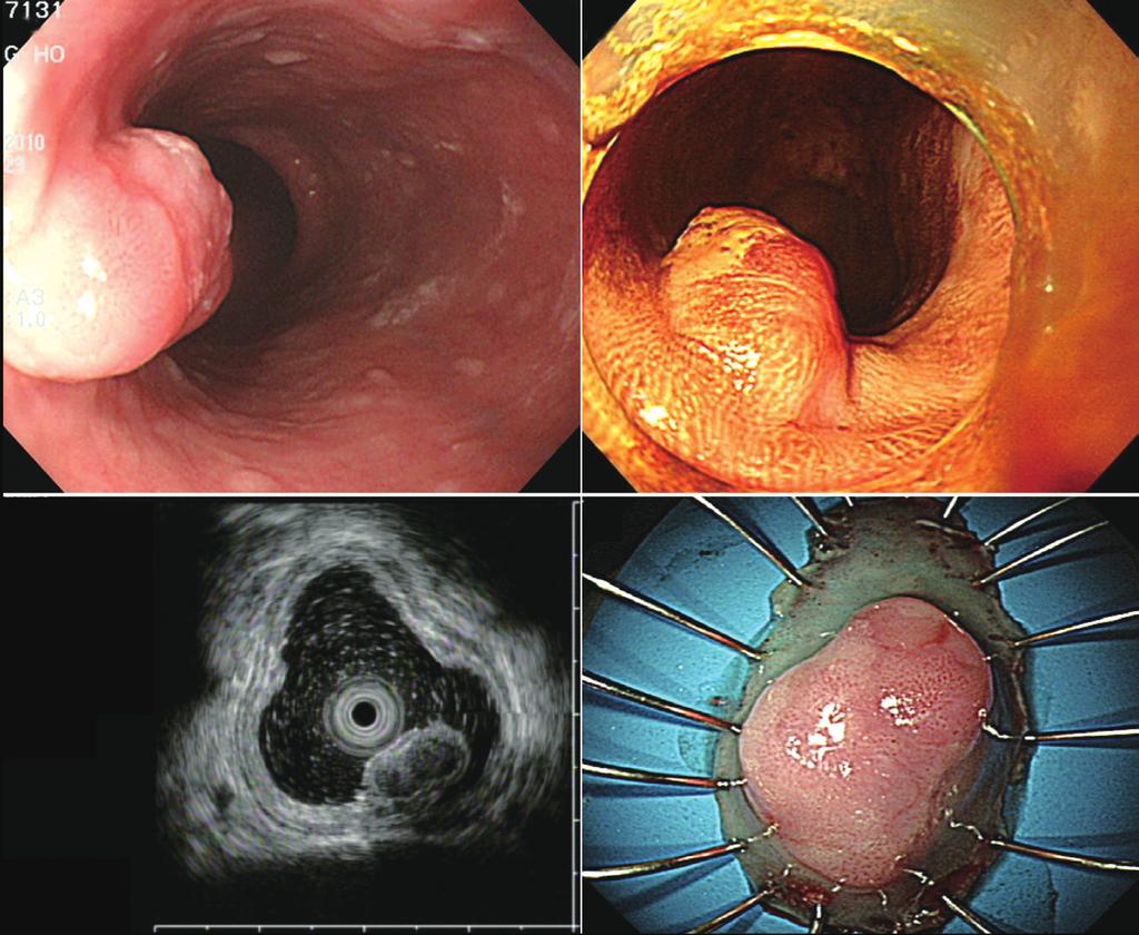 Seo M et al. Esophageal Neoplasm Overlying a Leiomyoma A B C D Fig. 1. (A) An endoscopic image shows a subepithelial tumor with an eroded surface in the middle third of the esophagus.