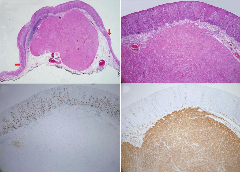 A B C D Fig. 2. (A) Histopathologically, the resected lesion is a squamous cell carcinoma that overlies a leiomyoma in situ.