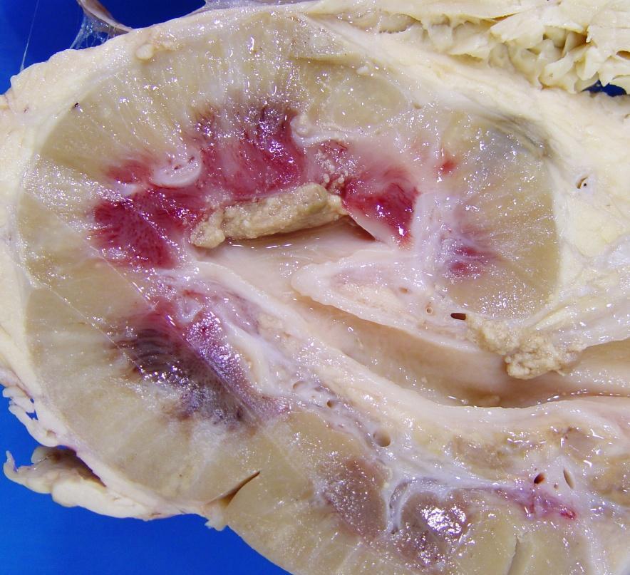 Inflammation Case 7 Kidneys from a cull dairy cow