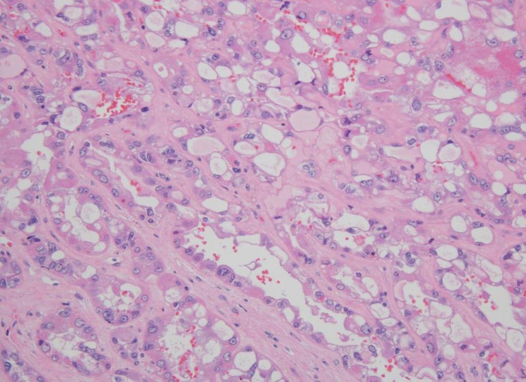 Acquired Cystic Disease-Associated RCC Most common neoplasm in the end-stage kidney setting Arise from cyst wall or adjacent parenchyma Multifocality and bilaterality