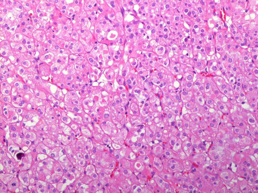 SDH-deficient RCC Typical vacuolated cytoplasm with