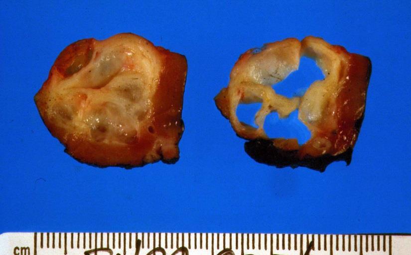 Multilocular cystic renal cell neoplasm of low malignant potential